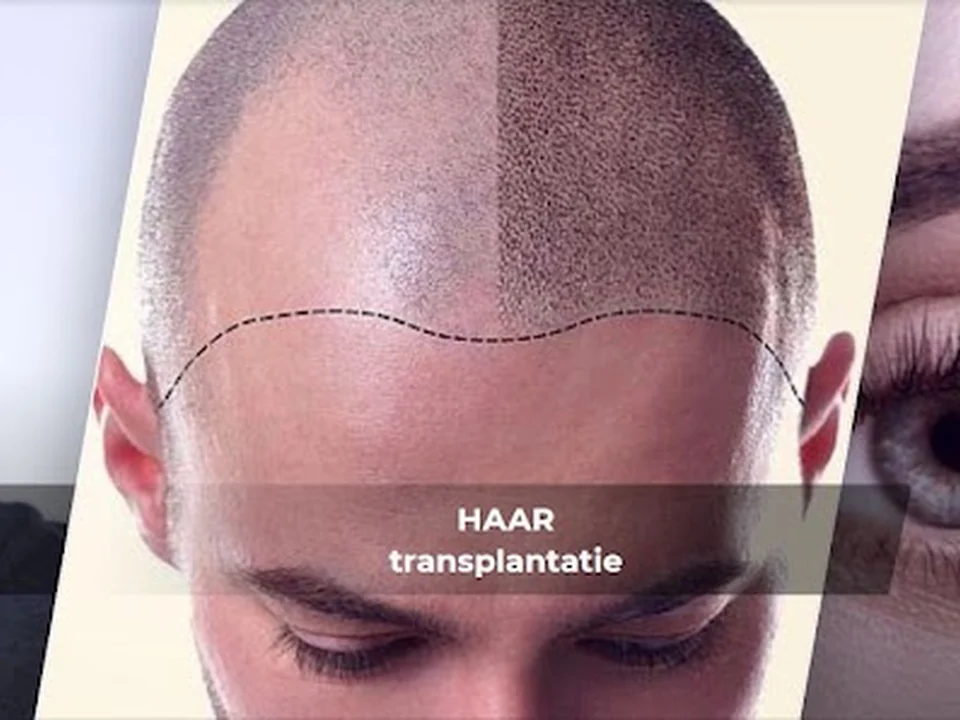 123 Haartransplantatie Turkije, Amsterdam